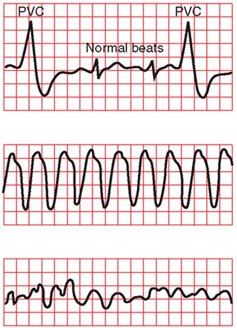 ekg readings abnormal|list of all ekg rhythms.